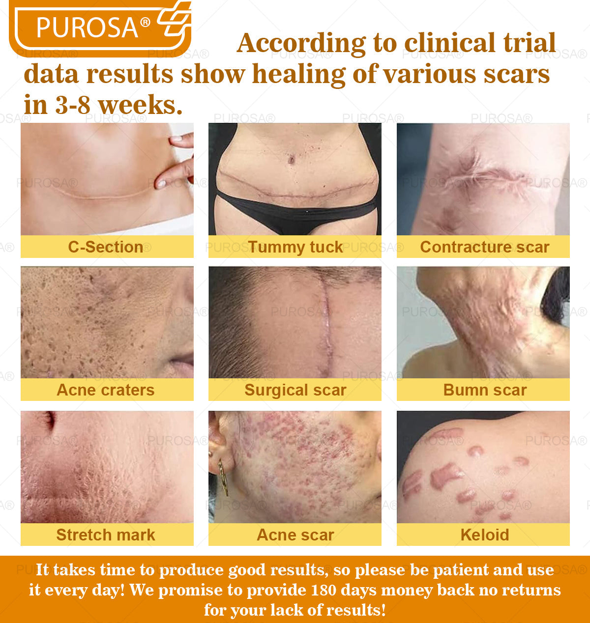 ✅PUROSA® Bee Venom Skin Treatment Cream, Anti-aging, Hydrating, Skin Repair, Even Tone, Acne and Dark Spot Treatment, Wart and Mole Removal, Psoriasis Relief