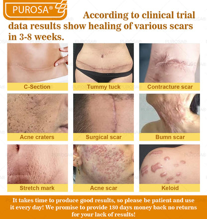 ✅PUROSA® Bee Venom Skin Treatment Cream, Anti-aging, Hydrating, Skin Repair, Even Tone, Acne and Dark Spot Treatment, Wart and Mole Removal, Psoriasis Relief