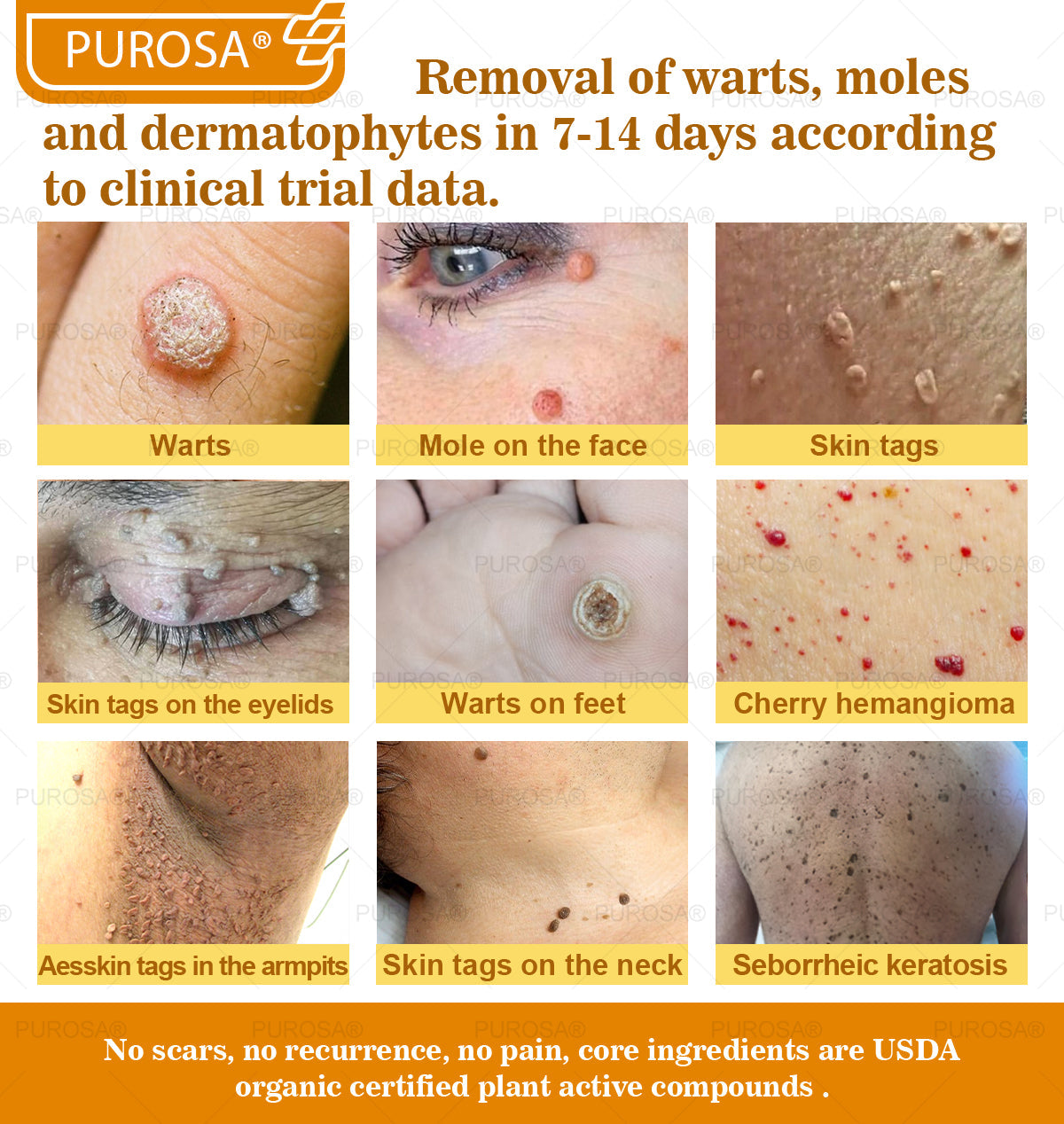 ✅PUROSA® Bee Venom Skin Treatment Cream, Anti-aging, Hydrating, Skin Repair, Even Tone, Acne and Dark Spot Treatment, Wart and Mole Removal, Psoriasis Relief