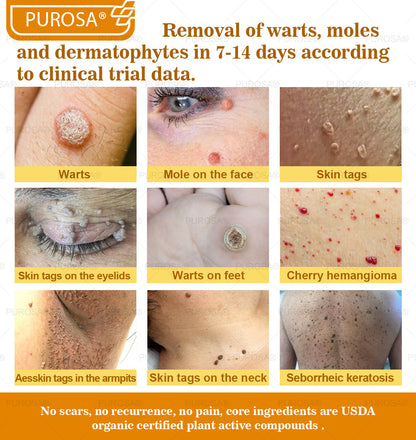 ✅PUROSA® Bee Venom Skin Treatment Cream, Anti-aging, Hydrating, Skin Repair, Even Tone, Acne and Dark Spot Treatment, Wart and Mole Removal, Psoriasis Relief