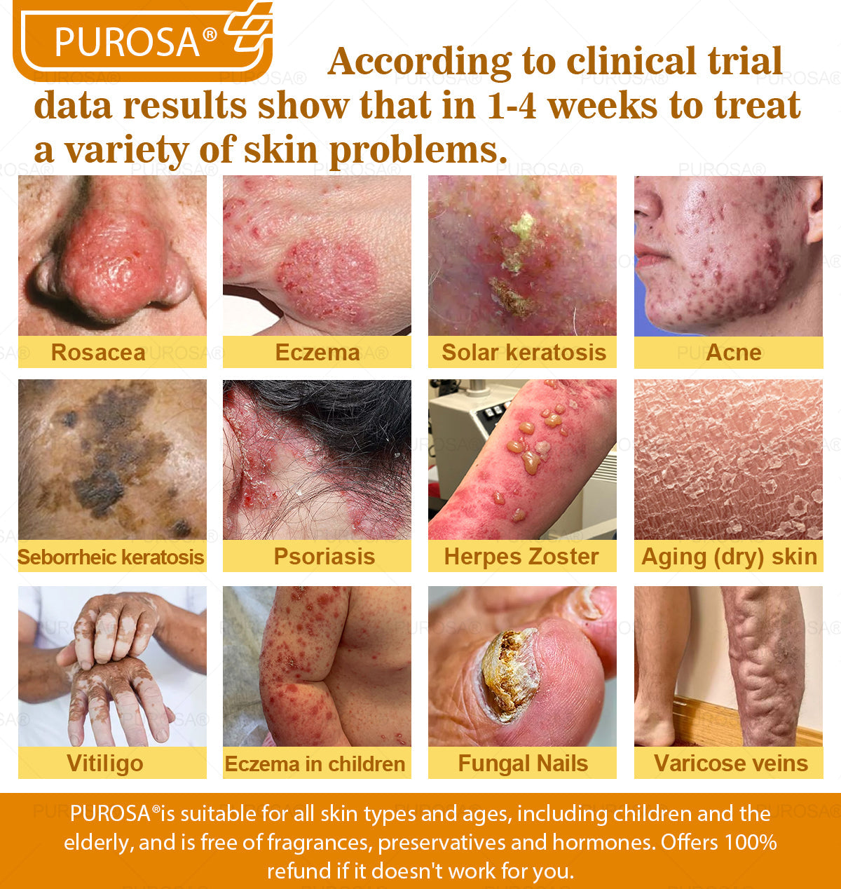 ✅PUROSA® Bee Venom Skin Treatment Cream, Anti-aging, Hydrating, Skin Repair, Even Tone, Acne and Dark Spot Treatment, Wart and Mole Removal, Psoriasis Relief
