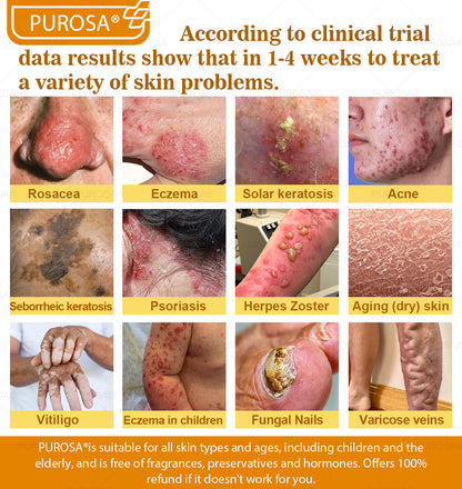 ✅PUROSA® Bee Venom Skin Treatment Cream, Anti-aging, Hydrating, Skin Repair, Even Tone, Acne and Dark Spot Treatment, Wart and Mole Removal, Psoriasis Relief